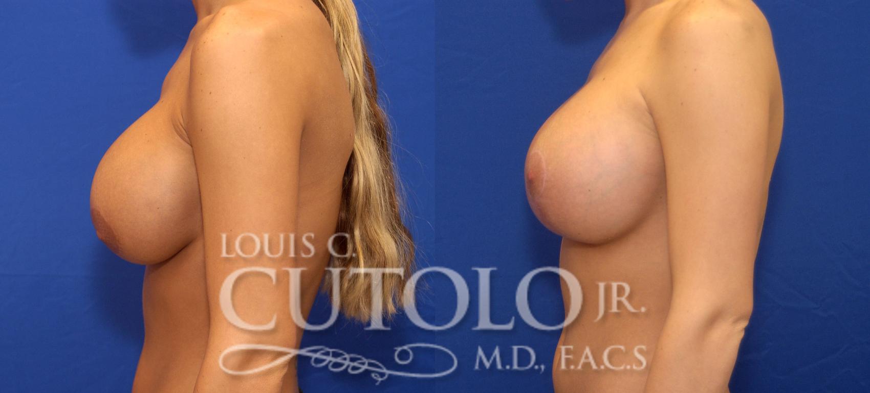 Before & After Breast Augmentation Case 35 View #7 View in Brooklyn, Staten Island, Queens, NY