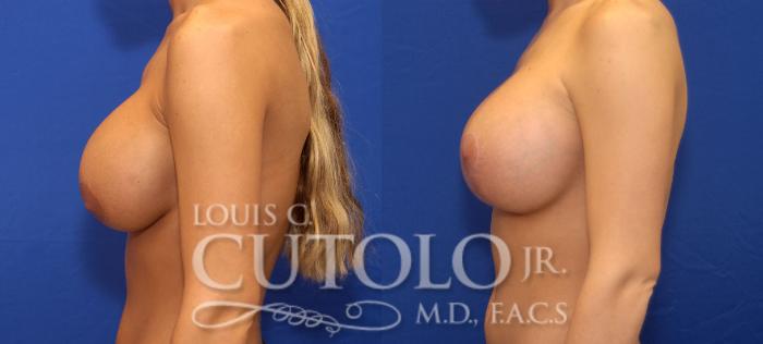 Before & After Breast Augmentation Case 35 View #7 View in Brooklyn, Staten Island, Queens, NY