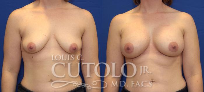 Before & After Breast Augmentation Case 37 View #1 View in Brooklyn, Staten Island, Queens, NY