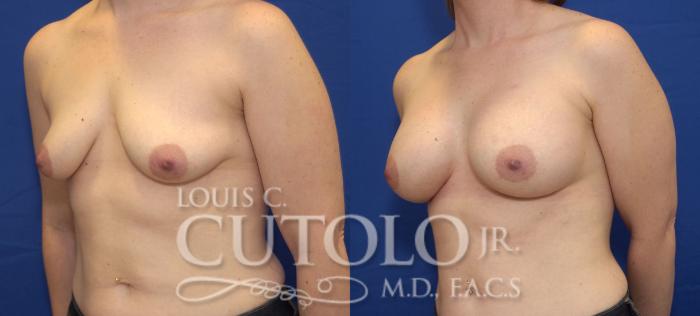 Before & After Breast Augmentation Case 37 View #2 View in Brooklyn, Staten Island, Queens, NY