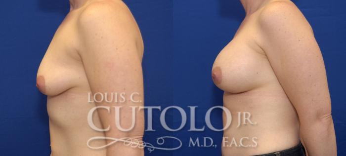 Before & After Breast Augmentation Case 37 View #3 View in Brooklyn, Staten Island, Queens, NY