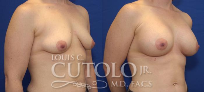 Before & After Breast Augmentation Case 37 View #4 View in Brooklyn, Staten Island, Queens, NY