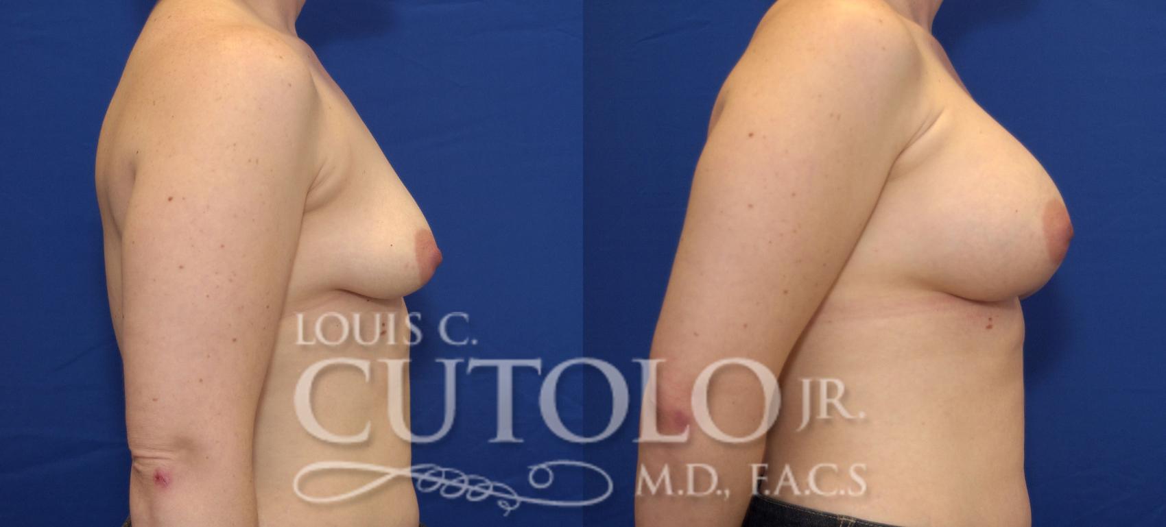 Before & After Breast Augmentation Case 37 View #5 View in Brooklyn, Staten Island, Queens, NY