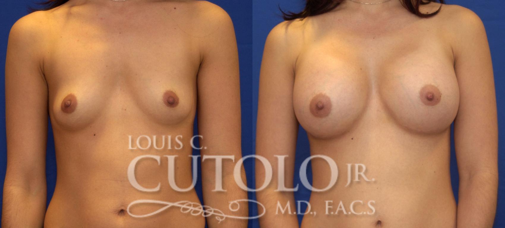 Before & After Breast Augmentation Case 38 View #1 View in Brooklyn, Staten Island, Queens, NY