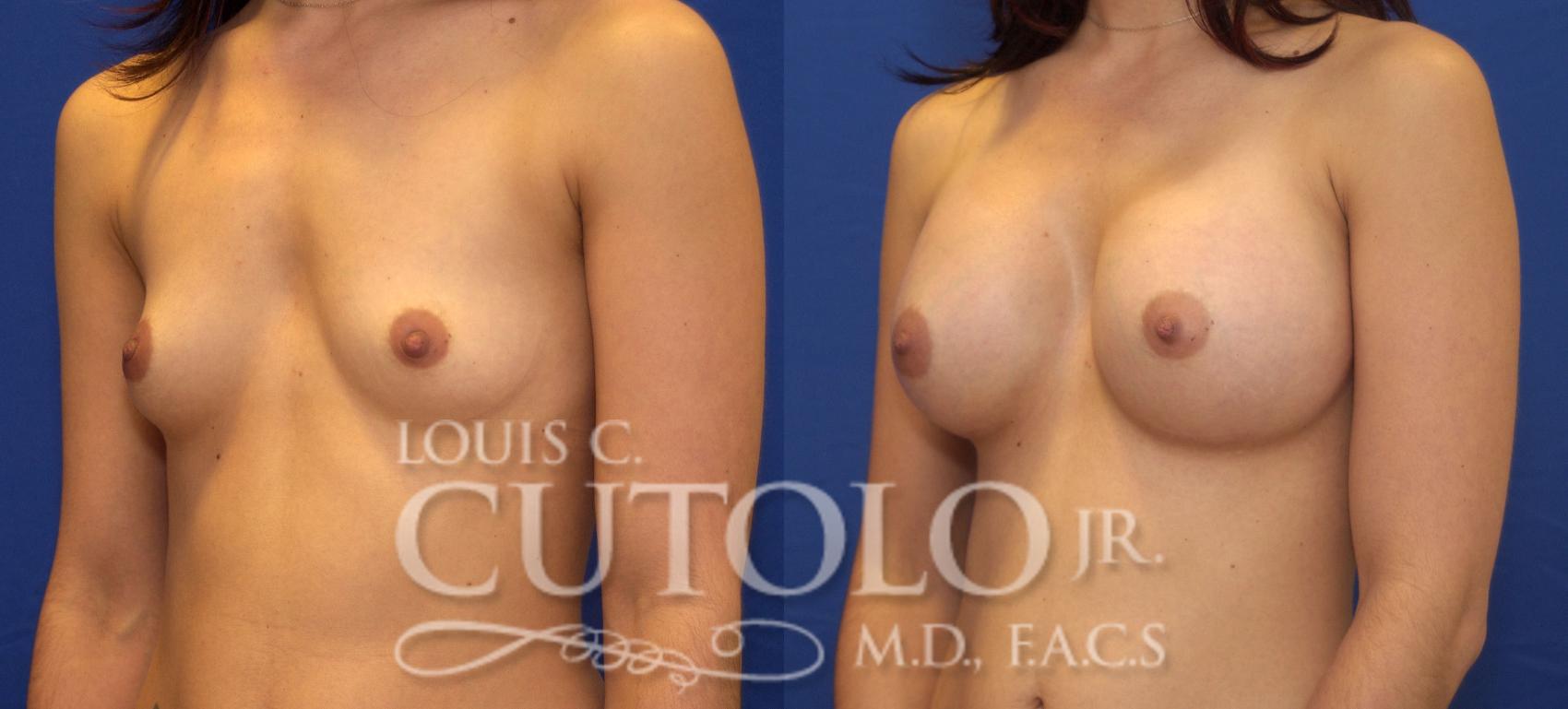 Before & After Breast Augmentation Case 38 View #2 View in Brooklyn, Staten Island, Queens, NY
