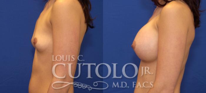 Before & After Breast Augmentation Case 38 View #3 View in Brooklyn, Staten Island, Queens, NY