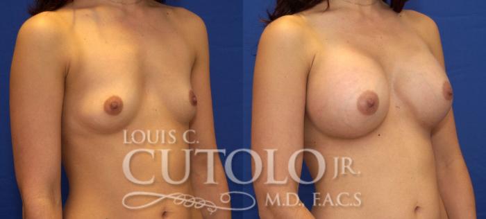 Before & After Breast Augmentation Case 38 View #4 View in Brooklyn, Staten Island, Queens, NY
