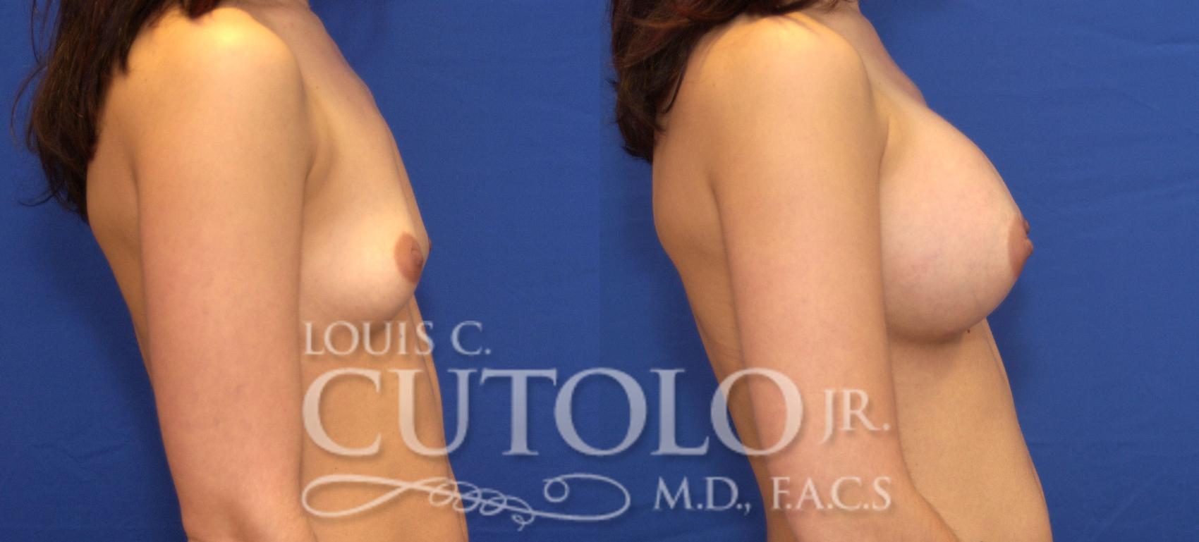 Before & After Breast Augmentation Case 38 View #5 View in Brooklyn, Staten Island, Queens, NY