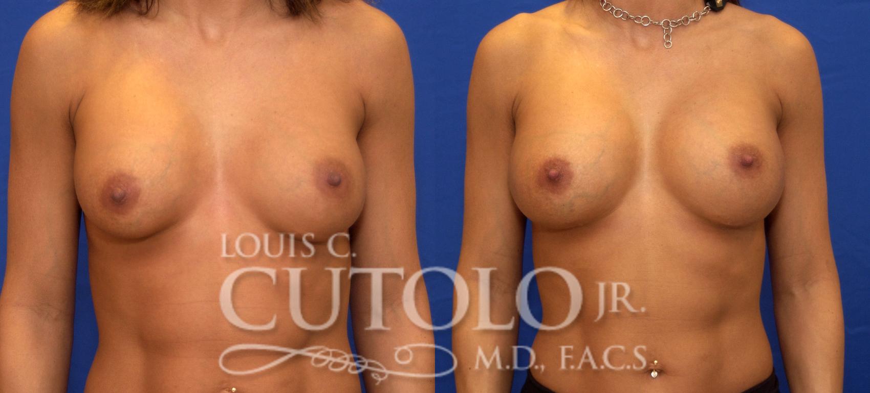 Before & After Breast Augmentation Case 39 View #1 View in Brooklyn, Staten Island, Queens, NY