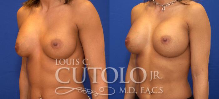 Before & After Breast Augmentation Case 39 View #2 View in Brooklyn, Staten Island, Queens, NY