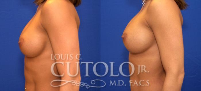 Before & After Breast Augmentation Case 39 View #3 View in Brooklyn, Staten Island, Queens, NY