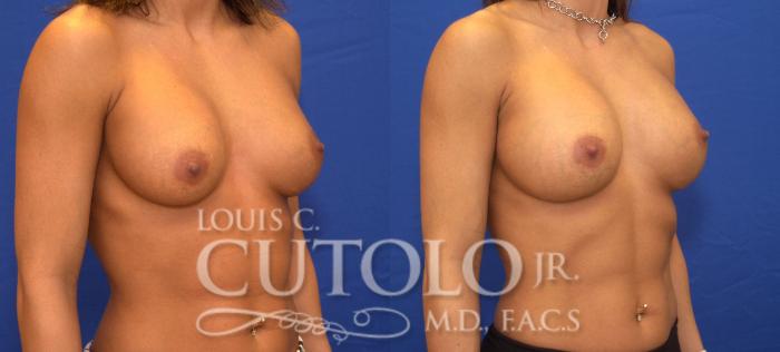 Before & After Breast Augmentation Case 39 View #4 View in Brooklyn, Staten Island, Queens, NY