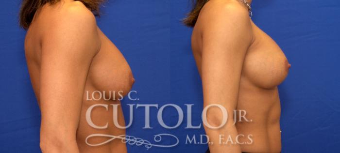 Before & After Breast Augmentation Case 39 View #5 View in Brooklyn, Staten Island, Queens, NY