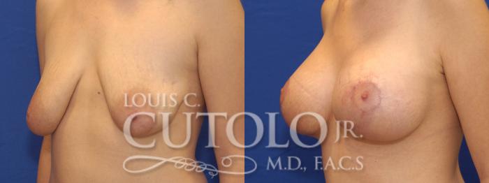 Before & After Breast Augmentation Case 4 View #2 View in Brooklyn, Staten Island, Queens, NY