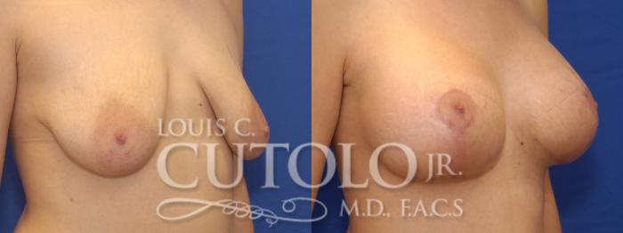 Before & After Breast Augmentation Case 4 View #3 View in Brooklyn, Staten Island, Queens, NY
