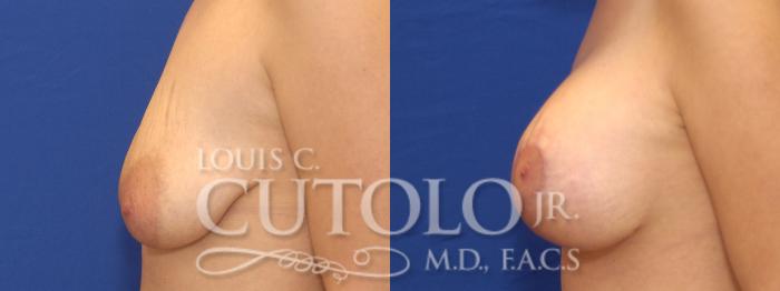Before & After Breast Augmentation Case 4 View #4 View in Brooklyn, Staten Island, Queens, NY