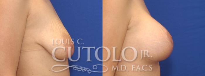 Before & After Breast Augmentation Case 4 View #5 View in Brooklyn, Staten Island, Queens, NY