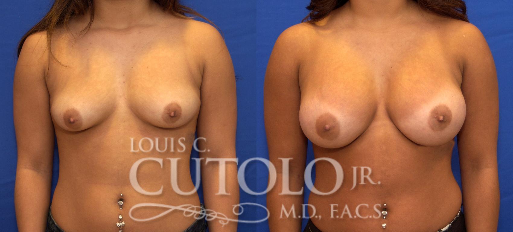 Before & After Breast Augmentation Case 40 View #1 View in Brooklyn, Staten Island, Queens, NY