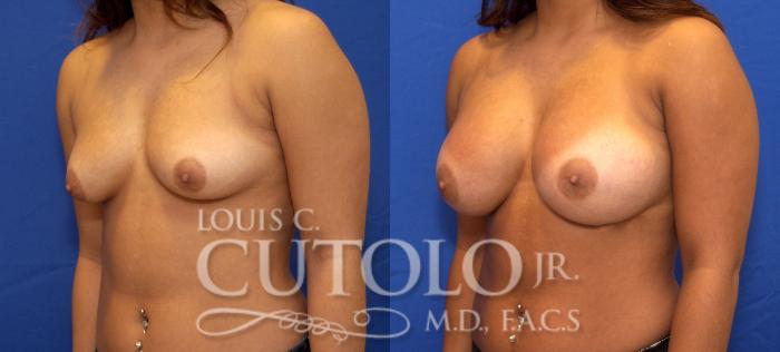 Before & After Breast Augmentation Case 40 View #2 View in Brooklyn, Staten Island, Queens, NY