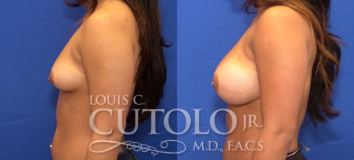 Before & After Breast Augmentation Case 40 View #3 View in Brooklyn, Staten Island, Queens, NY