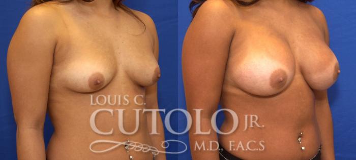 Before & After Breast Augmentation Case 40 View #4 View in Brooklyn, Staten Island, Queens, NY