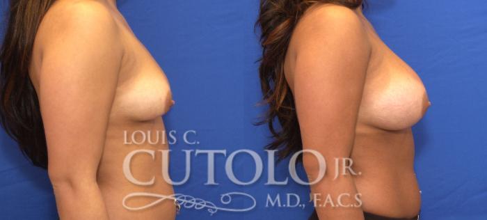 Before & After Breast Augmentation Case 40 View #5 View in Brooklyn, Staten Island, Queens, NY