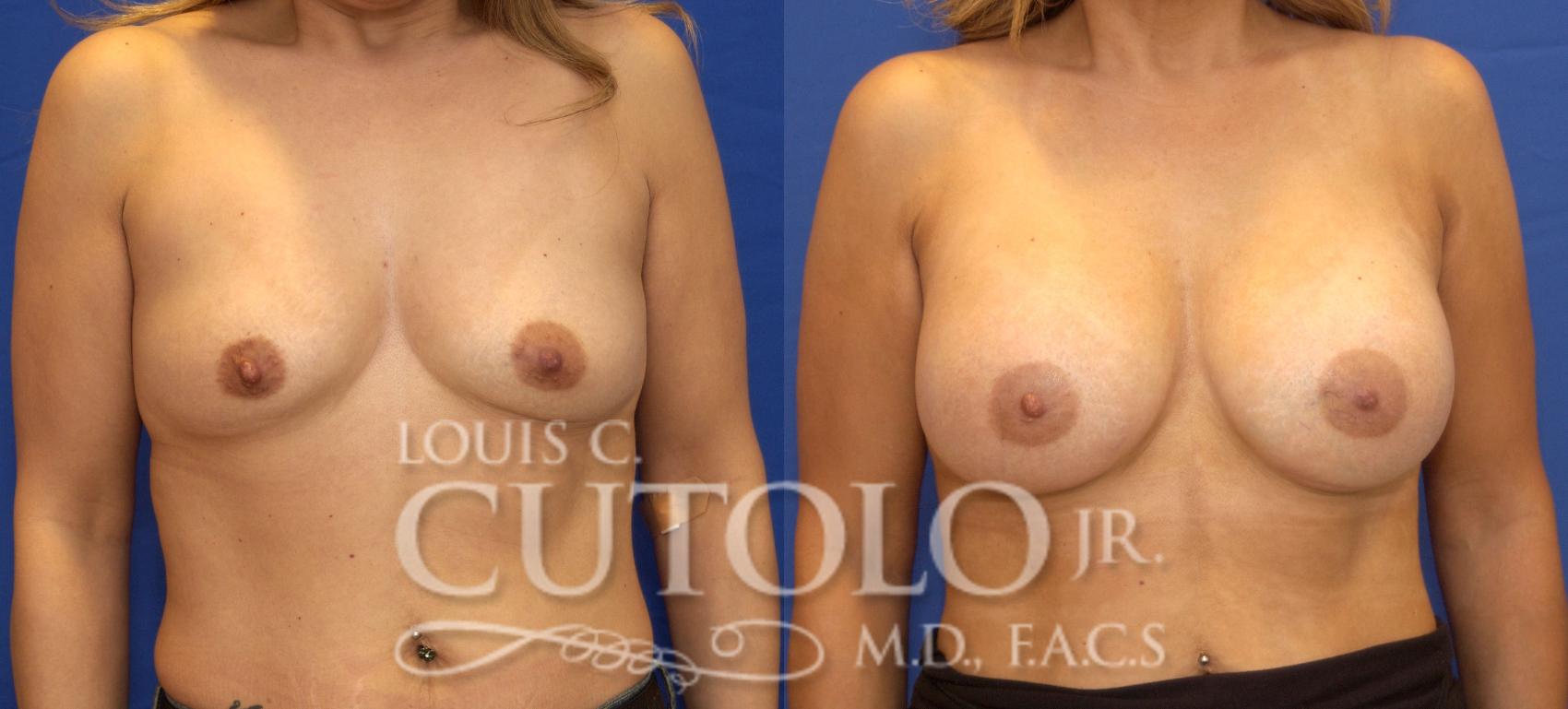 Before & After Breast Augmentation Case 42 View #1 View in Brooklyn, Staten Island, Queens, NY