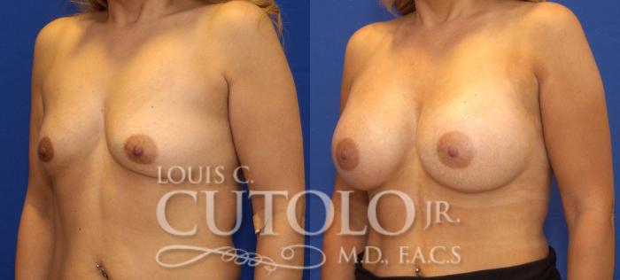 Before & After Breast Augmentation Case 42 View #2 View in Brooklyn, Staten Island, Queens, NY
