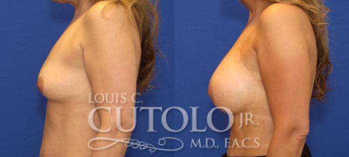 Before & After Breast Augmentation Case 42 View #3 View in Brooklyn, Staten Island, Queens, NY