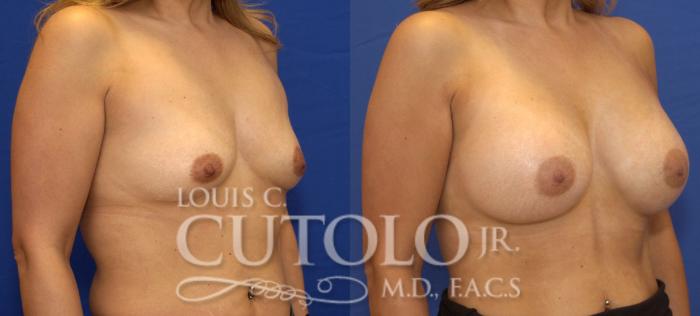 Before & After Breast Augmentation Case 42 View #4 View in Brooklyn, Staten Island, Queens, NY