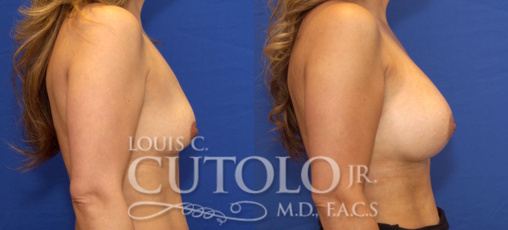 Before & After Breast Augmentation Case 42 View #5 View in Brooklyn, Staten Island, Queens, NY