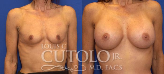 Before & After Breast Augmentation Case 43 View #1 View in Brooklyn, Staten Island, Queens, NY