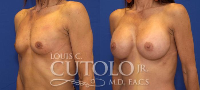 Before & After Breast Augmentation Case 43 View #2 View in Brooklyn, Staten Island, Queens, NY