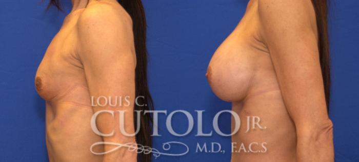 Before & After Breast Augmentation Case 43 View #3 View in Brooklyn, Staten Island, Queens, NY