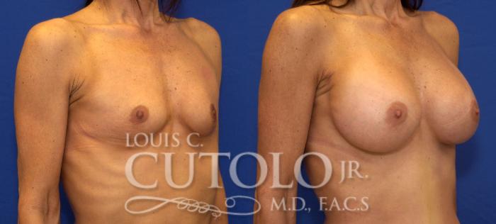 Before & After Breast Augmentation Case 43 View #4 View in Brooklyn, Staten Island, Queens, NY