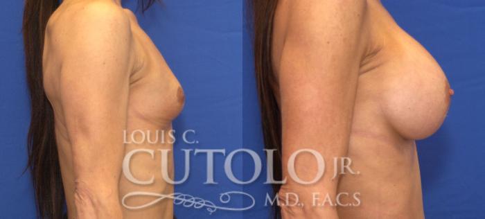 Before & After Breast Augmentation Case 43 View #5 View in Brooklyn, Staten Island, Queens, NY
