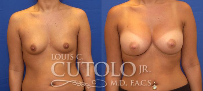 Before & After Breast Augmentation Case 47 View #1 View in Brooklyn, Staten Island, Queens, NY