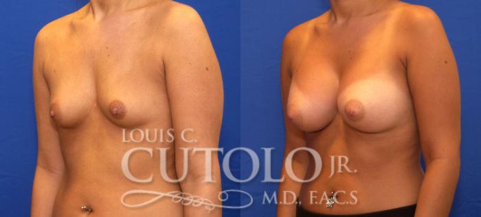 Before & After Breast Augmentation Case 47 View #2 View in Brooklyn, Staten Island, Queens, NY
