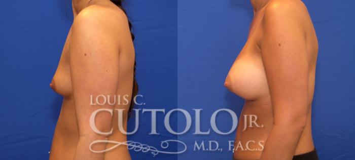 Before & After Breast Augmentation Case 47 View #3 View in Brooklyn, Staten Island, Queens, NY