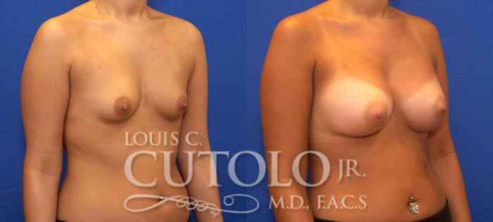 Before & After Breast Augmentation Case 47 View #4 View in Brooklyn, Staten Island, Queens, NY