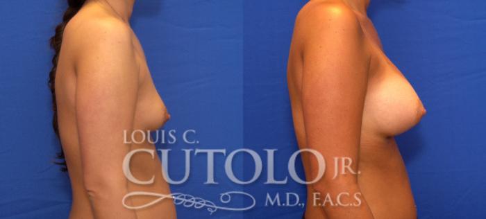 Before & After Breast Augmentation Case 47 View #5 View in Brooklyn, Staten Island, Queens, NY