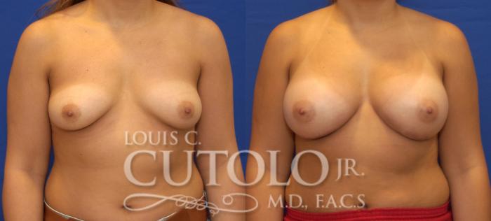 Before & After Breast Augmentation Case 49 View #1 View in Brooklyn, Staten Island, Queens, NY