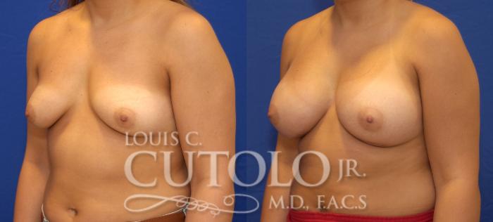 Before & After Breast Augmentation Case 49 View #2 View in Brooklyn, Staten Island, Queens, NY