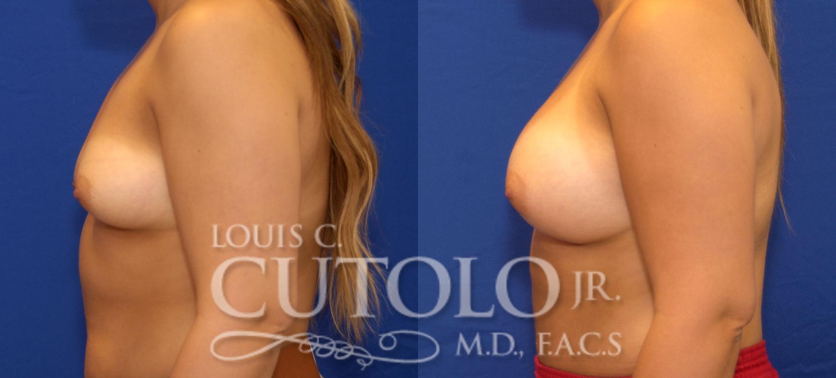 Before & After Breast Augmentation Case 49 View #3 View in Brooklyn, Staten Island, Queens, NY