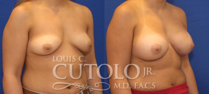 Before & After Breast Augmentation Case 49 View #4 View in Brooklyn, Staten Island, Queens, NY