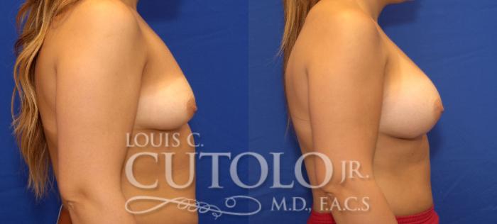 Before & After Breast Augmentation Case 49 View #5 View in Brooklyn, Staten Island, Queens, NY