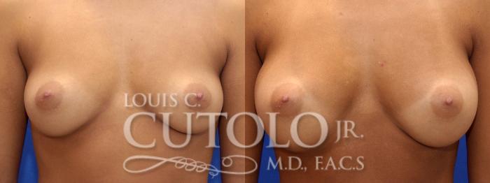 Before & After Breast Augmentation Case 5 View #1 View in Brooklyn, Staten Island, Queens, NY