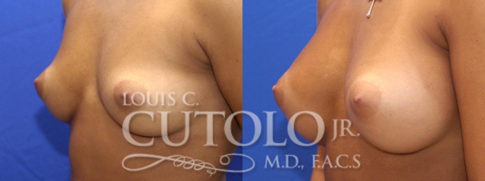 Before & After Breast Augmentation Case 5 View #2 View in Brooklyn, Staten Island, Queens, NY