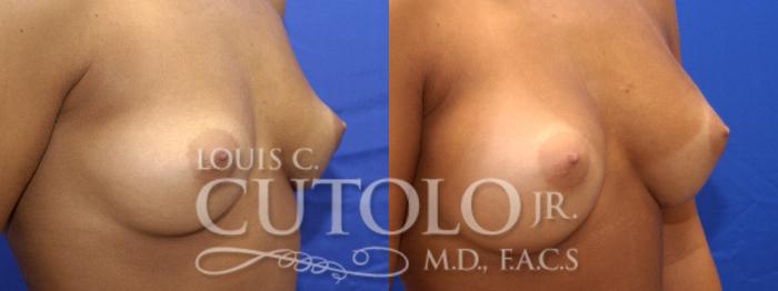 Before & After Breast Augmentation Case 5 View #3 View in Brooklyn, Staten Island, Queens, NY