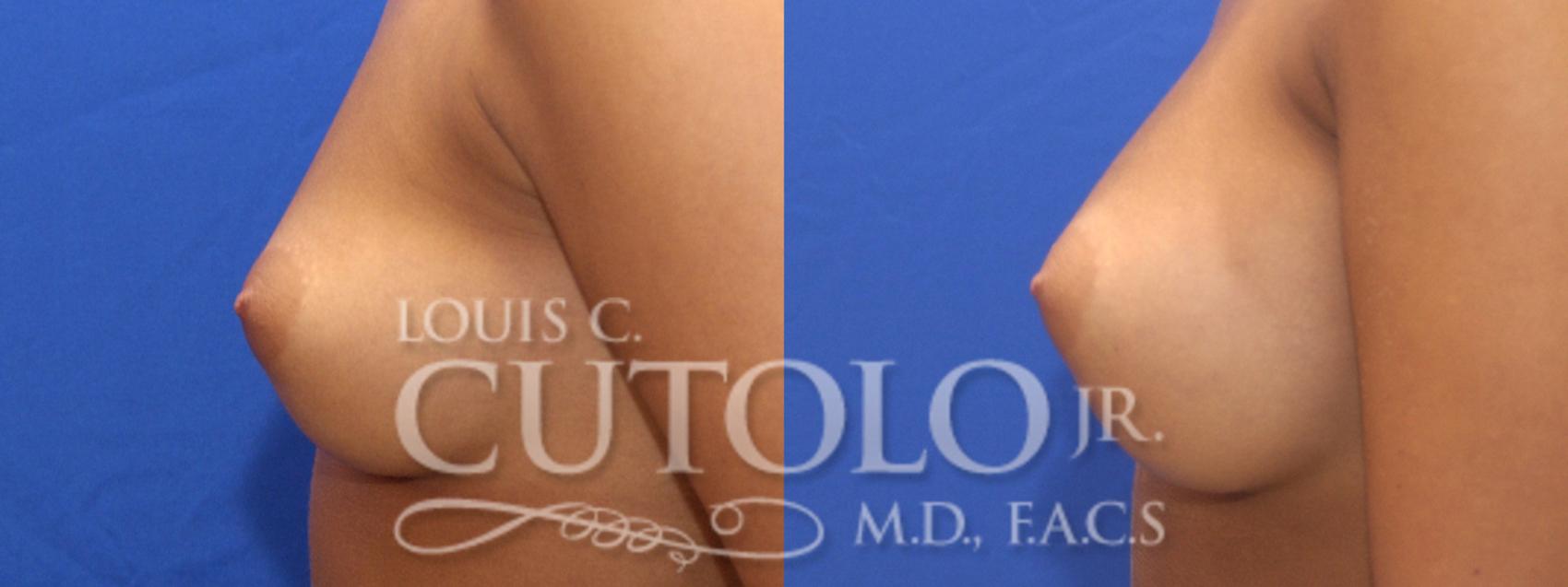 Before & After Breast Augmentation Case 5 View #4 View in Brooklyn, Staten Island, Queens, NY